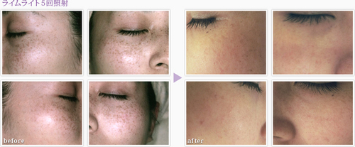 奈良のシミソバカス治療ライムライト　美容外科皮膚科ピュアメディカルクリニック1